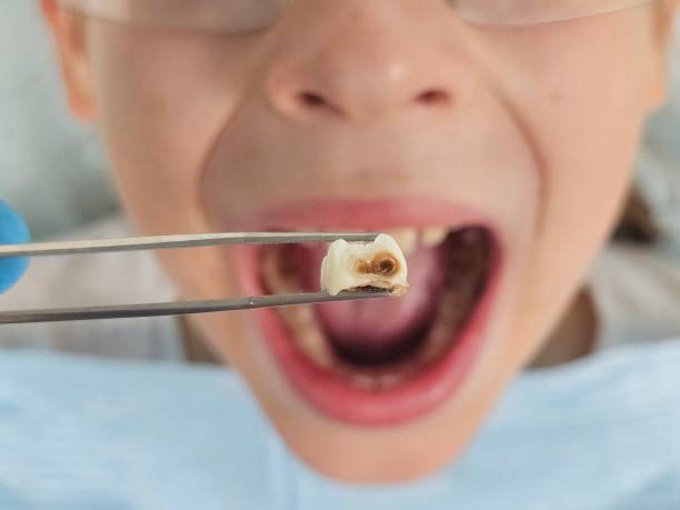 Best Emergency Broken Tooth Repair in Gueydan, LA
